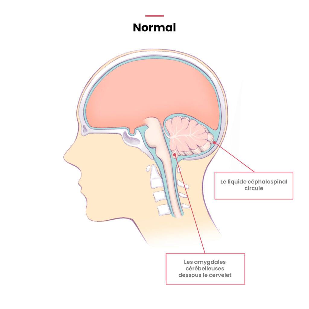 Position des amygdales cérébelleuses, IRM nomale