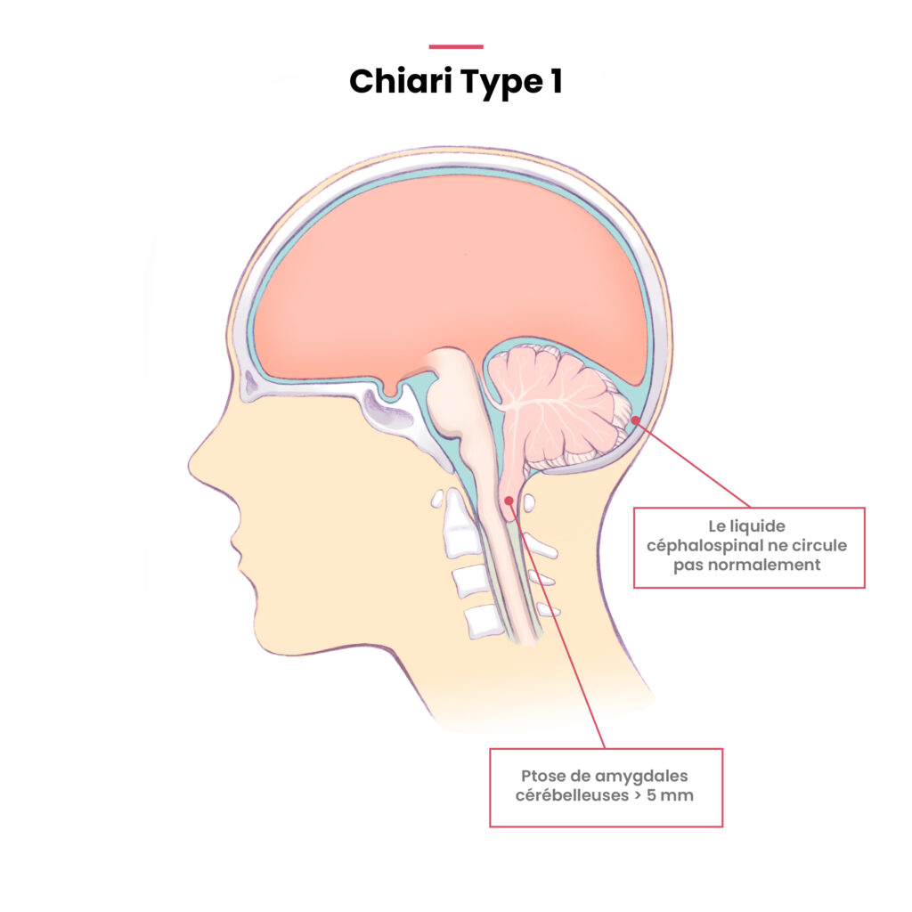 Position de amygdales cérébelleuses, IRM Chiari type 1