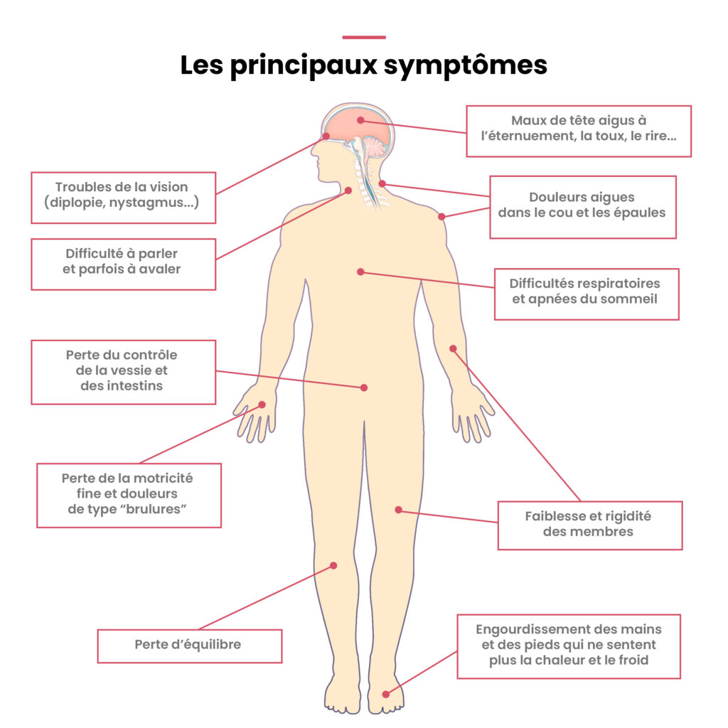 symptômes de la malformation de Chiari : nystagmus, diplopie, spasticité, pertes d'équilibre, brûlures, rigidité des membres, apnées du sommeil