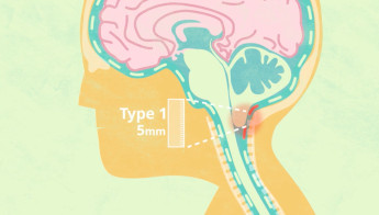 La malformation de Chiari