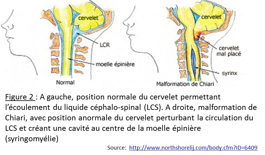 chiari avec syringomyélie